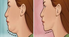 Cách giảm mỡ cổ tự nhiên và hiệu quả nhanh chóng Cách giảm mỡ cổ tự nhiên và hiệu quả nhanh chóng
